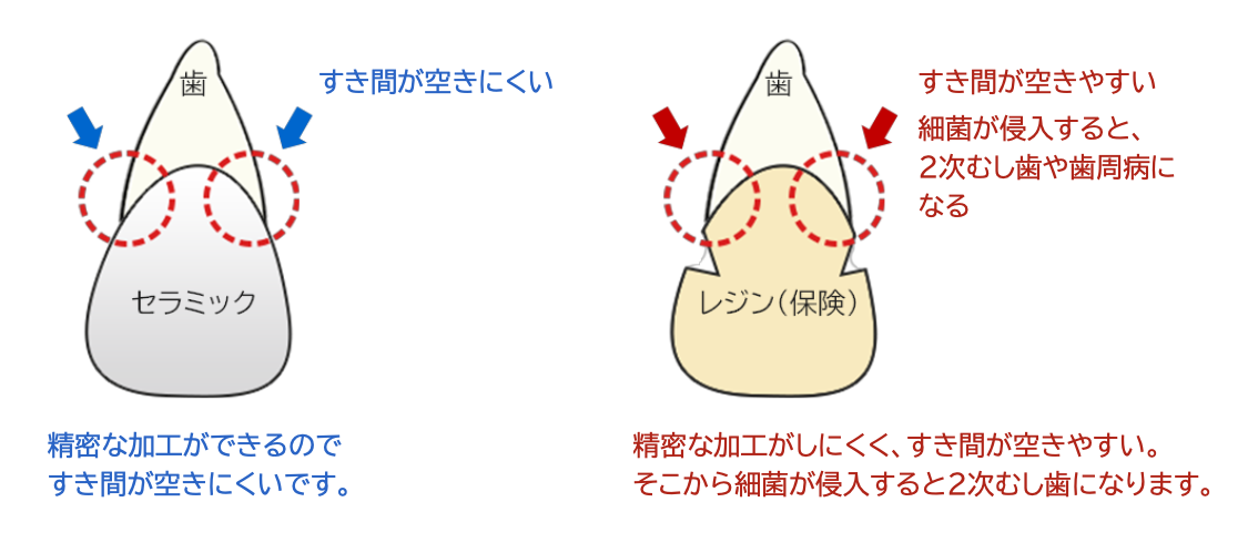 むし歯のなりにくさ