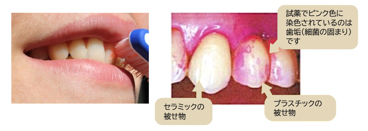 歯周病のなりにくさ